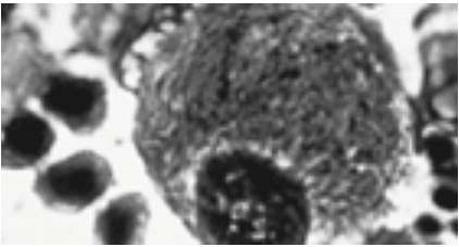 gaucher cells