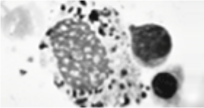 gaucher cells